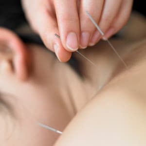 remboursement-acupuncture