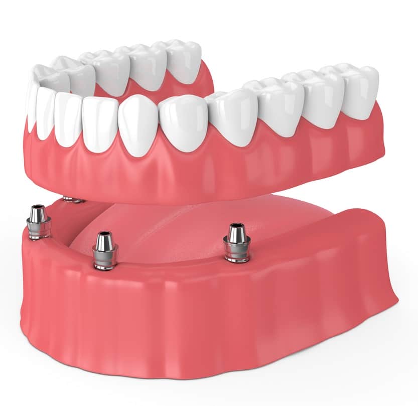 Optimisez le remboursement du dentier avec une bonne mutuelle