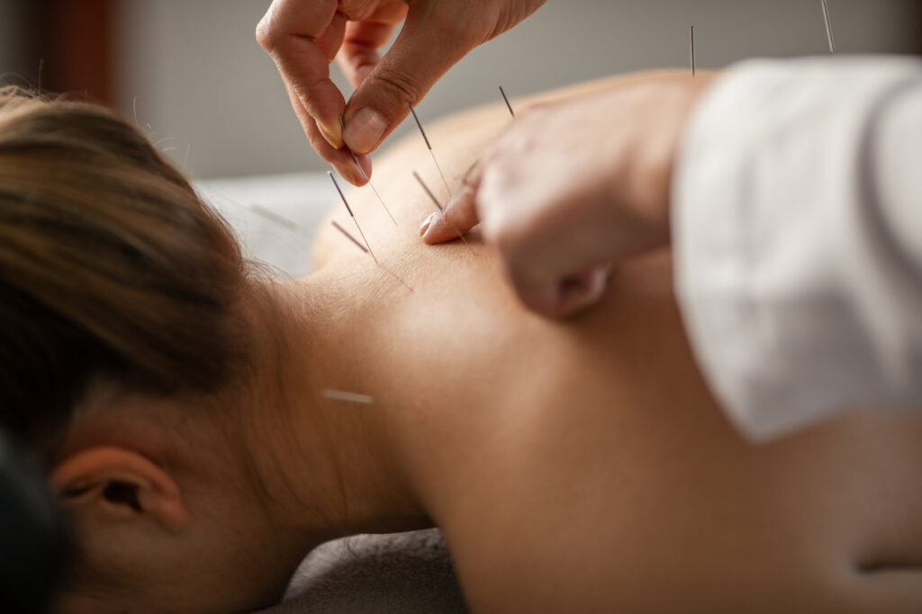 remboursement de l'acupuncture